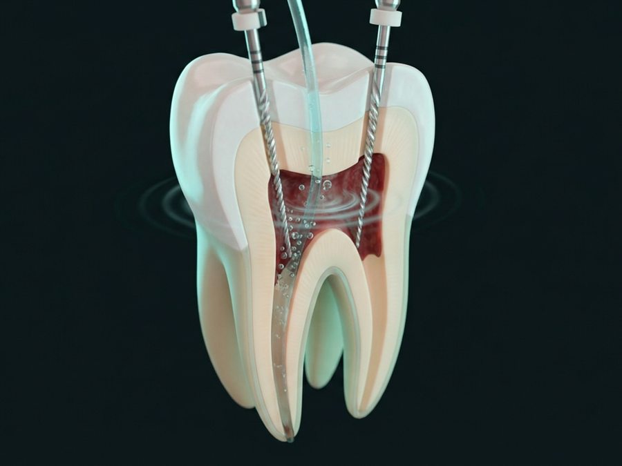 Ilustración: limas dentro de los conductos de un molar, con irrigación activada